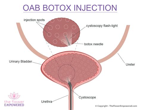 Icd 10 Code For Bladder Botox Injection