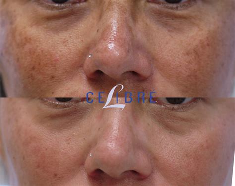 Melasma Before and After Pictures