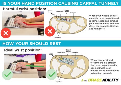 Carpal Tunnel Syndrome Symptoms, Wrist Injury Causes & Pain Treatment