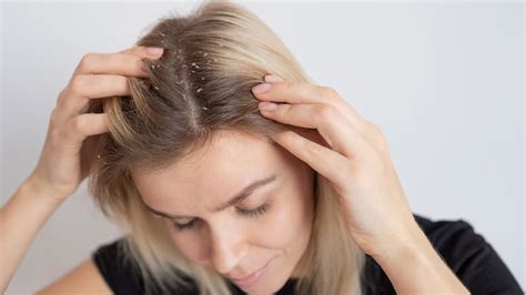 Redness On Scalp? Expert Lists Signs Of Scalp Eczema And Its Types | OnlyMyHealth