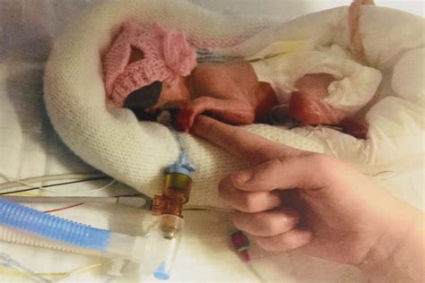 Born premature at 24 weeks, 'miracle' baby Francesca is beating all odds