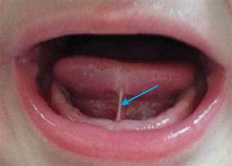 Ankyloglossia, definition, causes, symptoms, diagnosis, treatment ...