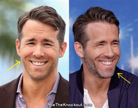 Ryan Reynolds Plastic Surgery Comparison Photos