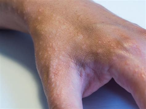 Dyshidrotic Dermatitis: Symptoms, Causes, Diagnosis, and Treatment