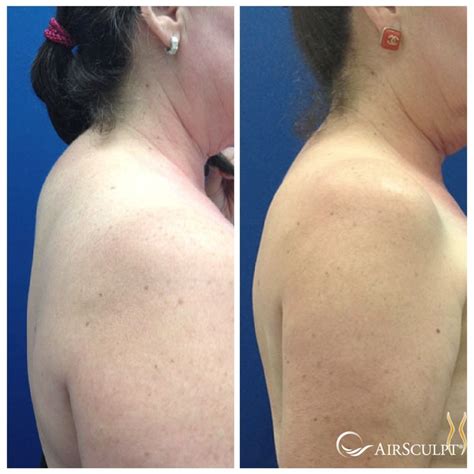 Pin on AirSculpt® Before & After - Elite Body Sculpture