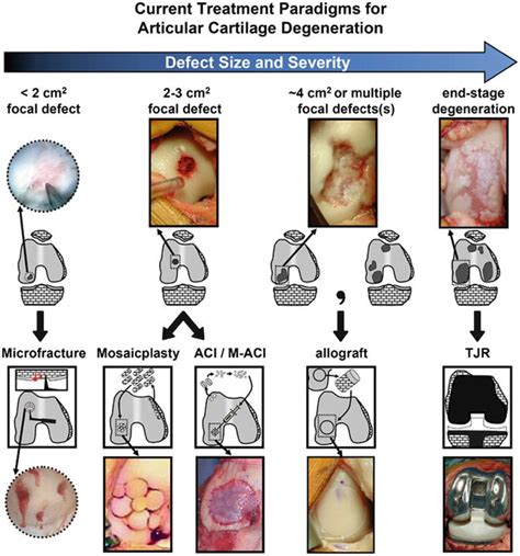 Hip Cartilage Restoration: Overview | Musculoskeletal Key