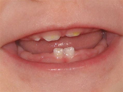 baby teeth turning yellow