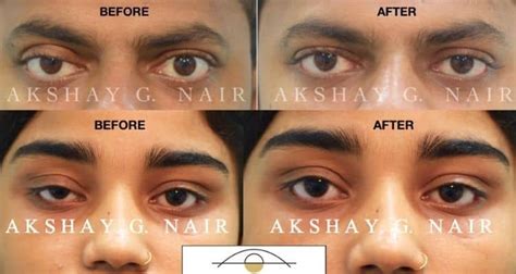 Ptosis or Droopy Eyelid Surgery | Mumbai | Eye Solutions