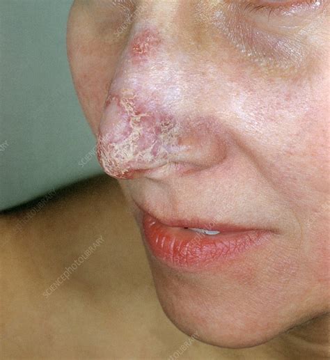 Lupus erythematosus on the nose - Stock Image - C013/1025 - Science Photo Library