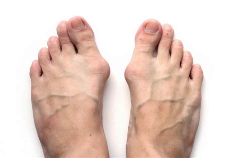 How to Get Rid of Bunions Without Surgery ? - Charlies Magazines