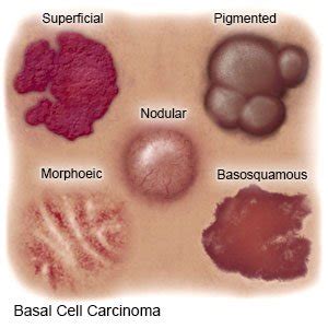 Basal Cell Carcinoma (Discharge Care) - What You Need to Know