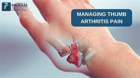 Managing Thumb Arthritis Pain: Strategies and Pain Relief Techniques ...