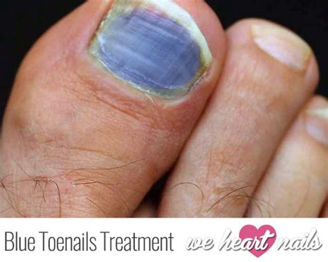 Bruised Blue Toenails? | Causes, Prevention & Treatments