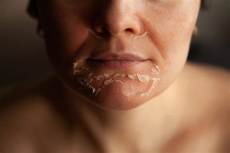 Piel seca y piel deshidratada: ¿Cómo diferenciarlas? — FMDOS