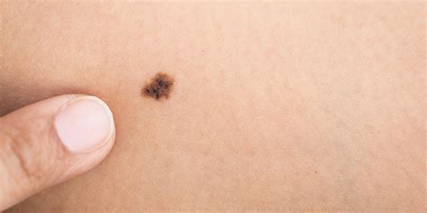 Melanoma and the Importance of Performing Skin Checks | HuffPost