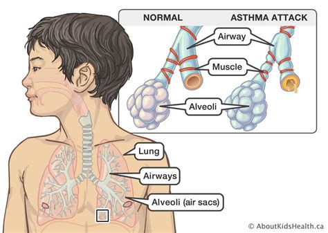 Pediatric Airway Obstruction Protocol