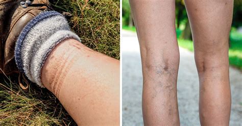 Socks Leave Marks On Legs: Causes And Treatment, 50% OFF