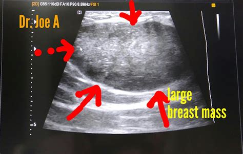 Ultrasound imaging: Giant-fibroadenoma-breast