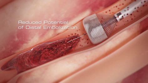 Surgical procedure to remove blood clot | Capture vascular machine