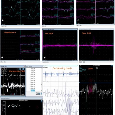 Bulbocavernosus reflex study. The response is recorded from the... | Download Scientific Diagram