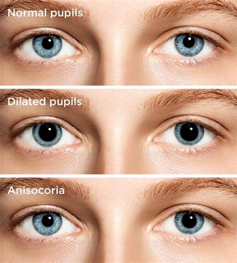 Dilated pupils: Causes, concerns and treatment | All About Vision