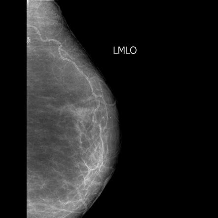 Vascular calcification in breast | Radiology Reference Article ...