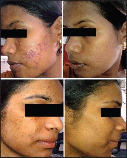 Before and after photographs of patients in isotretinoin + salicylic... | Download Scientific ...