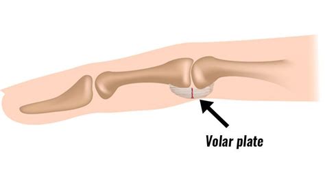 Volar plate injury - Symptoms, Causes & Treatment.