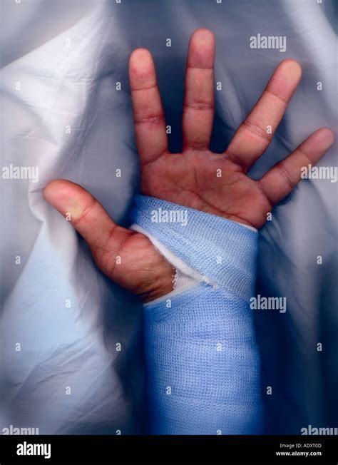 Color Studio shot of a fractured wrist in a fiberglass cast Stock Photo - Alamy