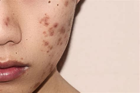 Cystic Acne Scars