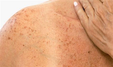 Sun Damaged Skin Treatment Geelong | CRC Geelong