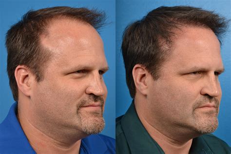 Hair Restoration Photos | Melbourne, FL | Patient 57533