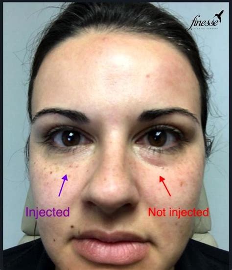 Botox Bags Under Your Eyes Before And After » Facial Injections: Info, Prices, Photos, Reviews, Q&A