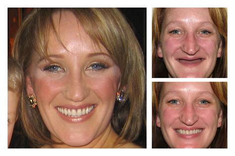 Extreme Makeover Before And After Teeth