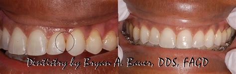 Black triangle teeth treatment options - Bauer Smiles