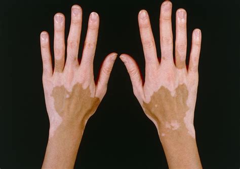 Hypopigmentation