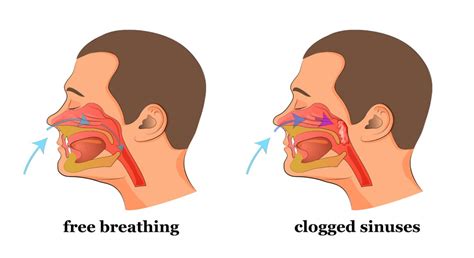 Do You Have a Stuffed Nose Or Clogged Sinuses? This Simple Trick Will Clear It In a Few Seconds.