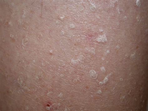 Stuccokeratosis - Simptomi