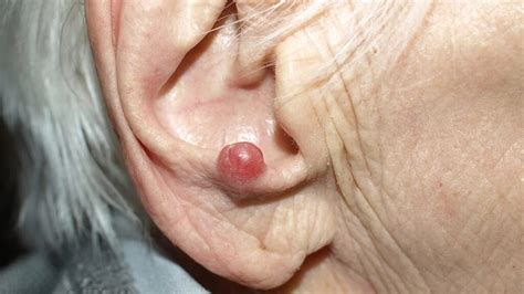 Merkel cell carcinoma: Causes, symptoms, and treatment