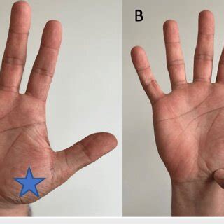 First carpometacarpal joint (A) Location of the first carpometacarpal... | Download Scientific ...