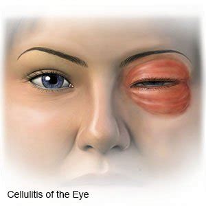 Periorbital Cellulitis - What You Need to Know