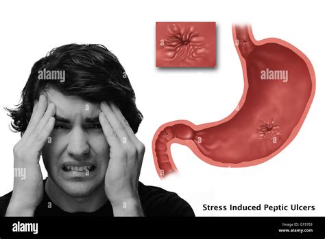 Conceptual image of stress induced ulcers. In the illustrated stomach there is an esophageal ...