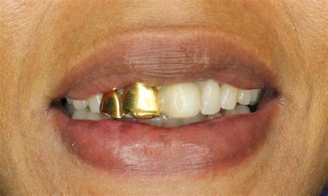 Gold Crowns | Before & After | Hopewell Family Dentistry