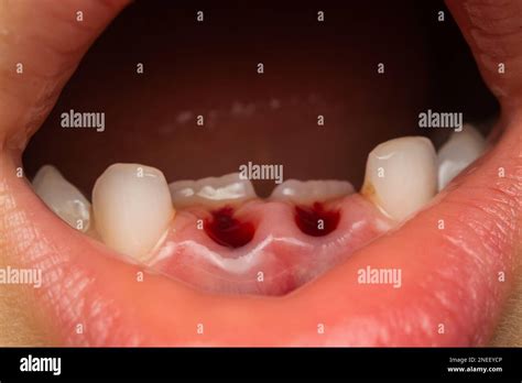 child mouth after deciduous teeth extraction Stock Photo - Alamy