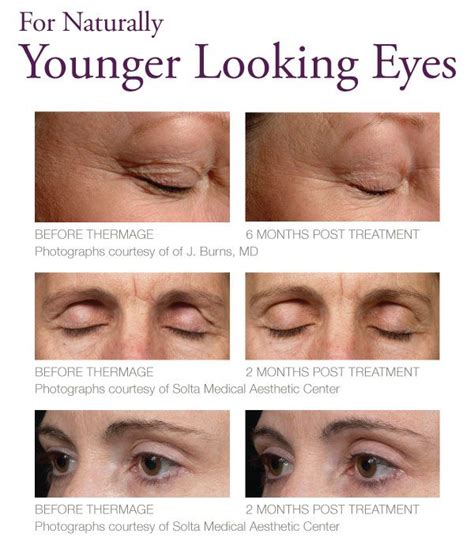 Thermage for eyes - The Skiny | Thermage, Laser skin tightening, Droopy eyes