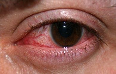 Eye Infections, Fungal; Mycosis, Ocular; Mycotic Infections, Ocular; Ocular Infections, Fungal ...