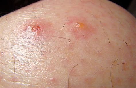 How do you know if you have chigger bites? - E Fitness Edge