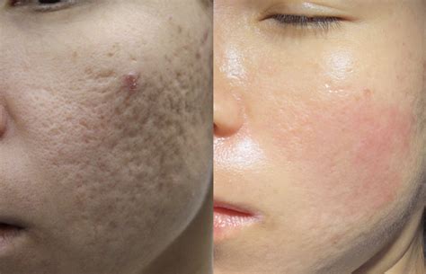 Acne Scars Treatment Malta at Susan Polo blog