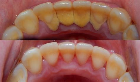 Monótono acceso retirarse dientes antes y despues de limpieza Alegre Todo tipo de Español