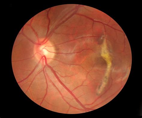 Puckering of Macula: Causes, Symptoms, and Treatments